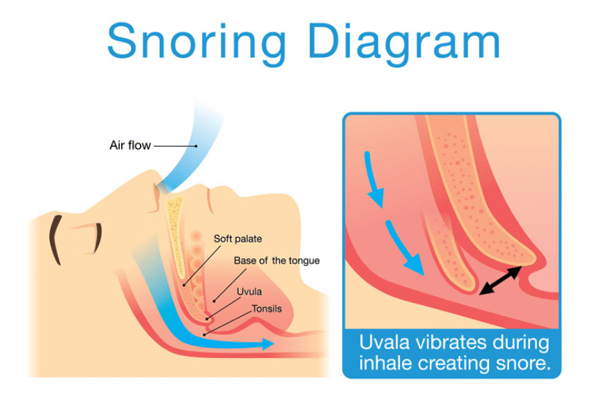 How to Stop Someone from Snoring. Tips and Tricks from an Expert. (Winter 2023)